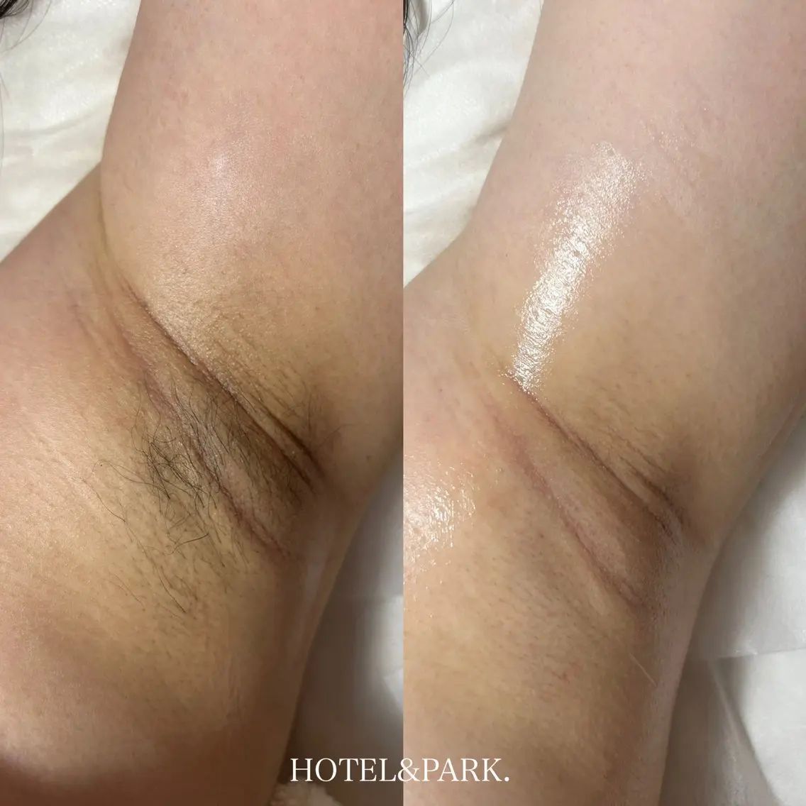 【両脇ワックス脱毛】の写真