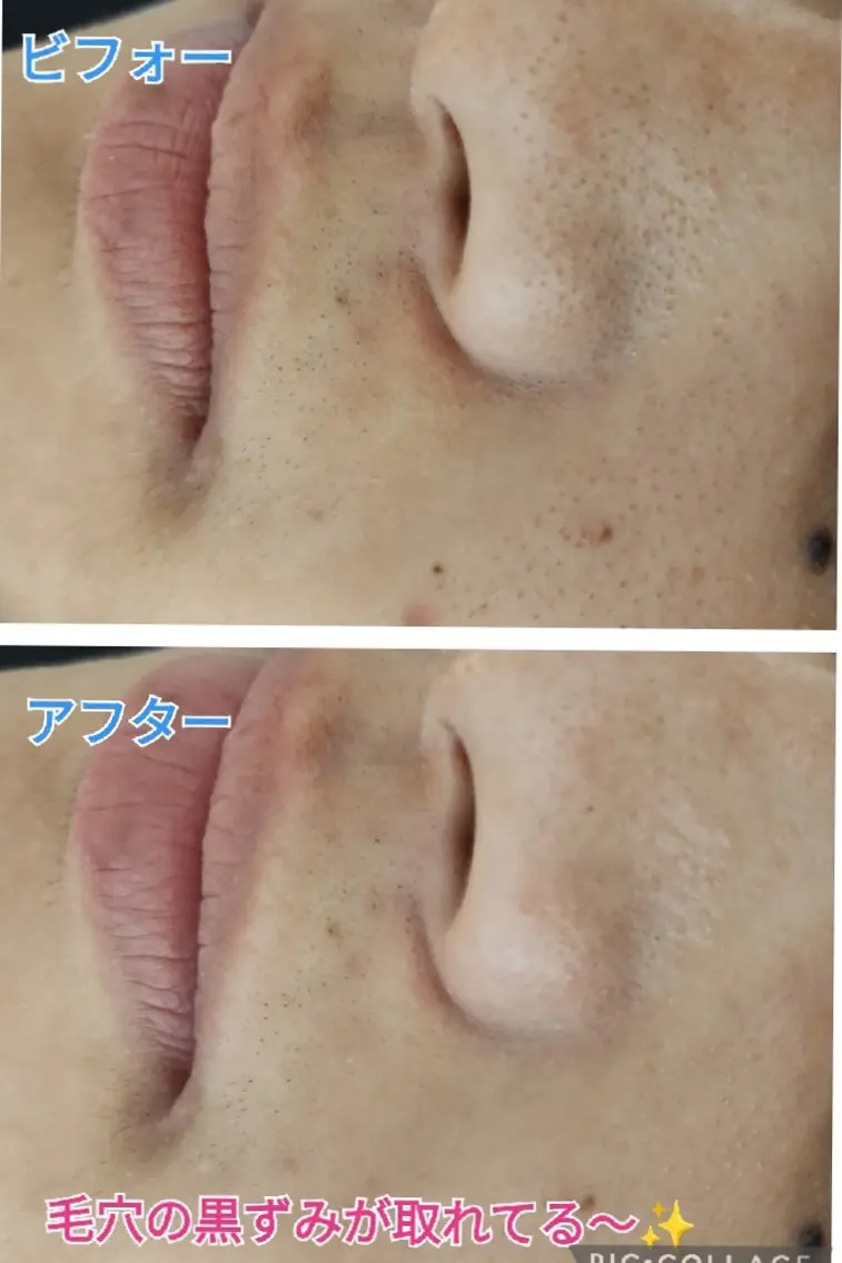 毛穴ケアフェイシャル✨の写真