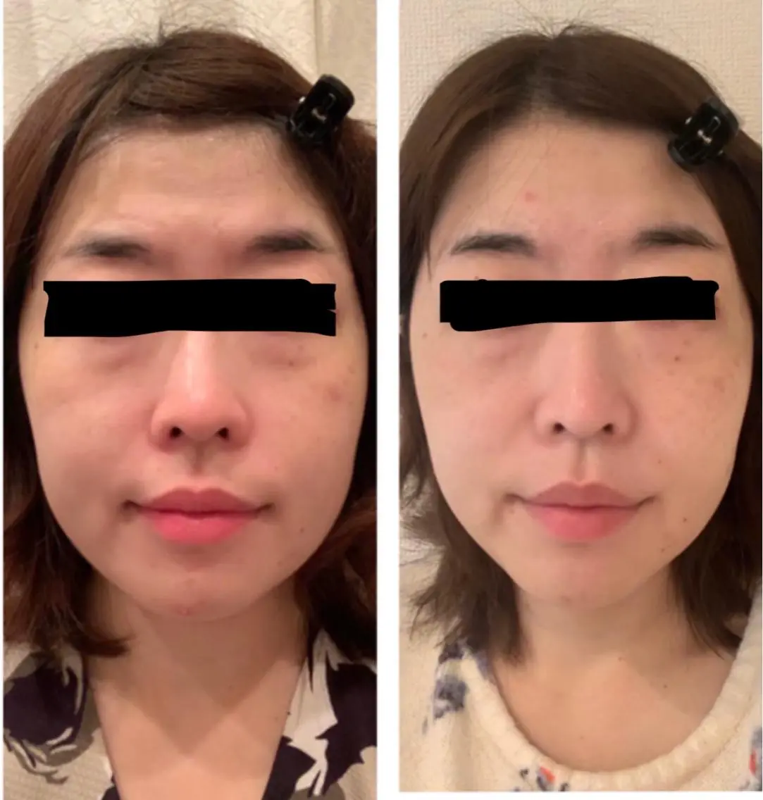 【新規限定】乾燥肌さん向け♪インナードライケア✨フェイシャルエステ💆♀️(2回分の施術分含んでます)の写真