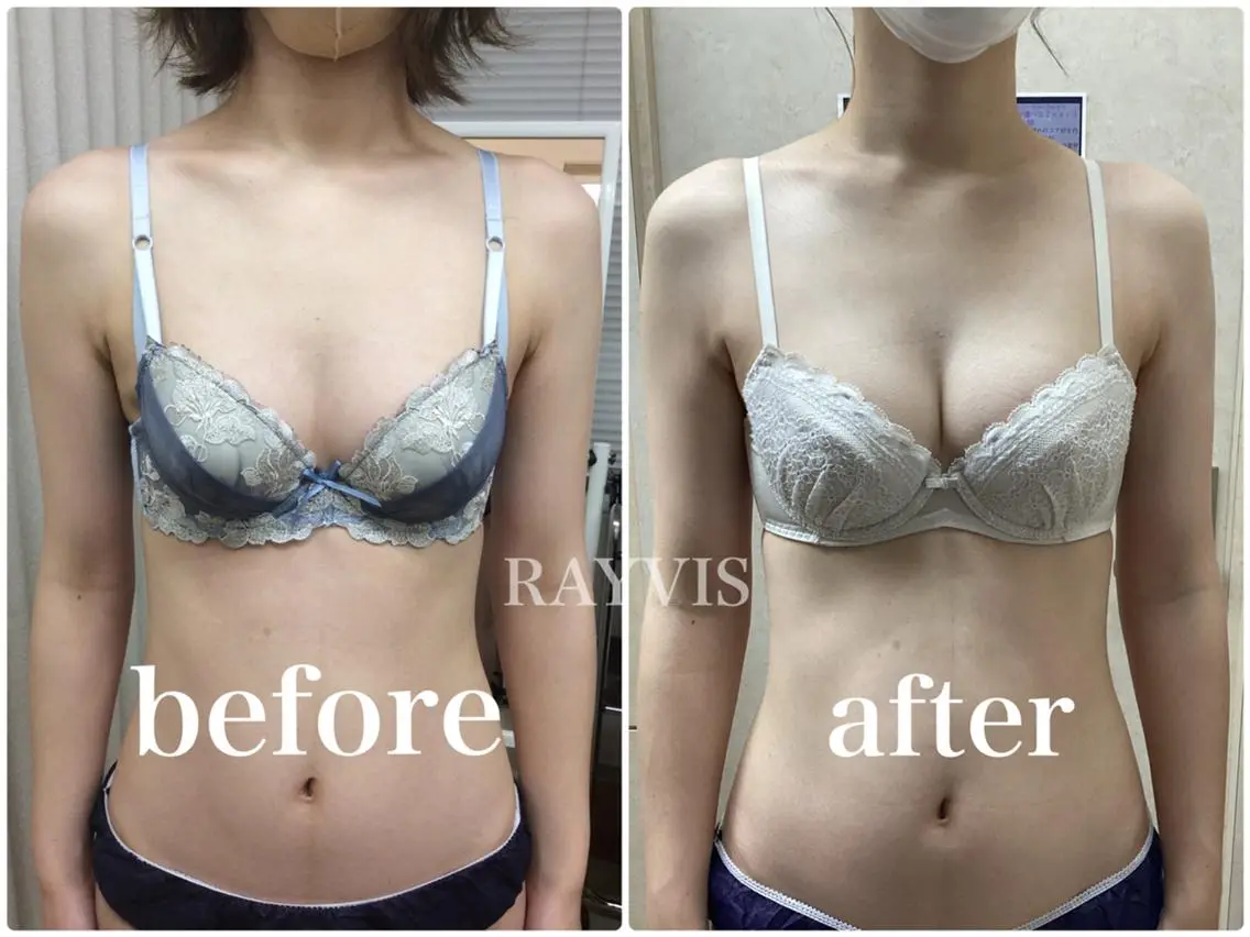 💗今流行りの最新バスト💗育乳マッサージ&光豊胸&EMSでマシュマロバストへ👙✨贅沢2回コース✨の写真