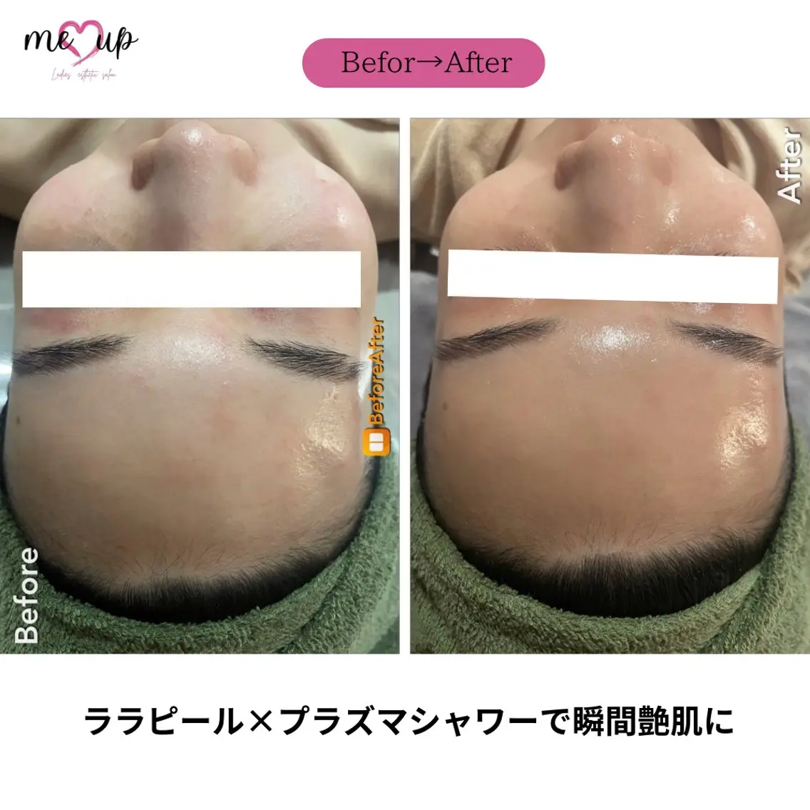 エステ Meupニキビ専門店 背中/ハーブ/肌管理のその他イメージ