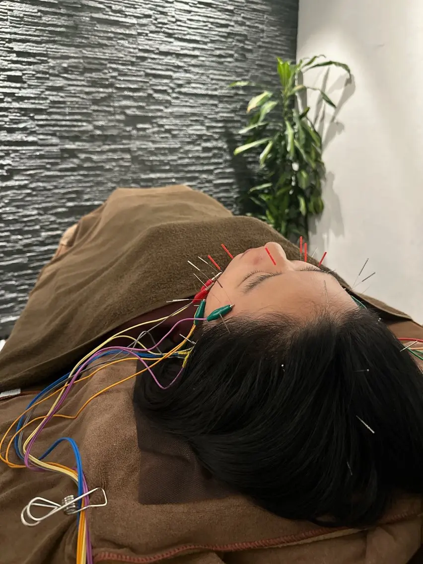 その他 小顔矯/美容鍼/鍼灸 BeauJuのその他イメージ