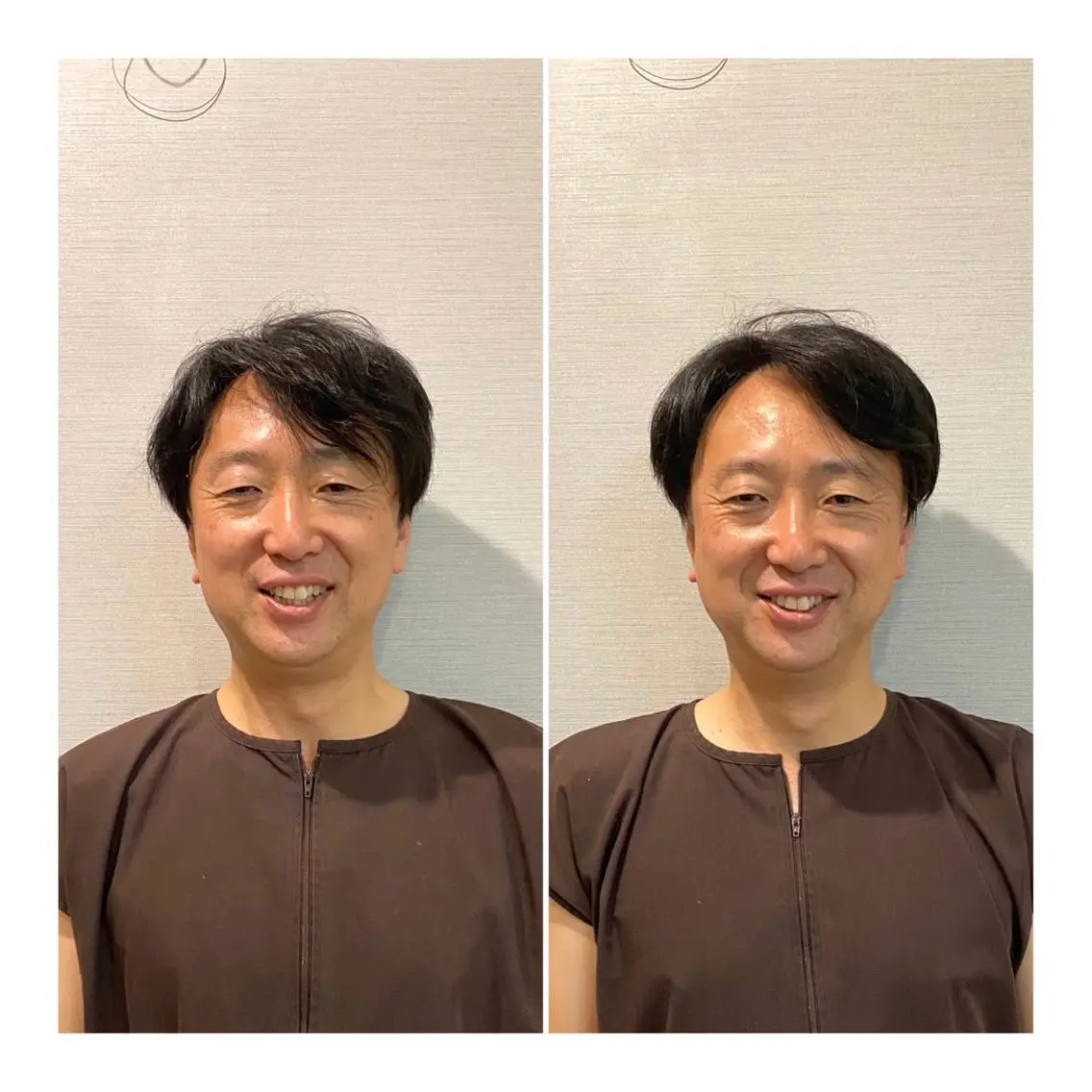 メンズ 即小顔♥️美容鍼× ハーブピーリングのその他イメージ