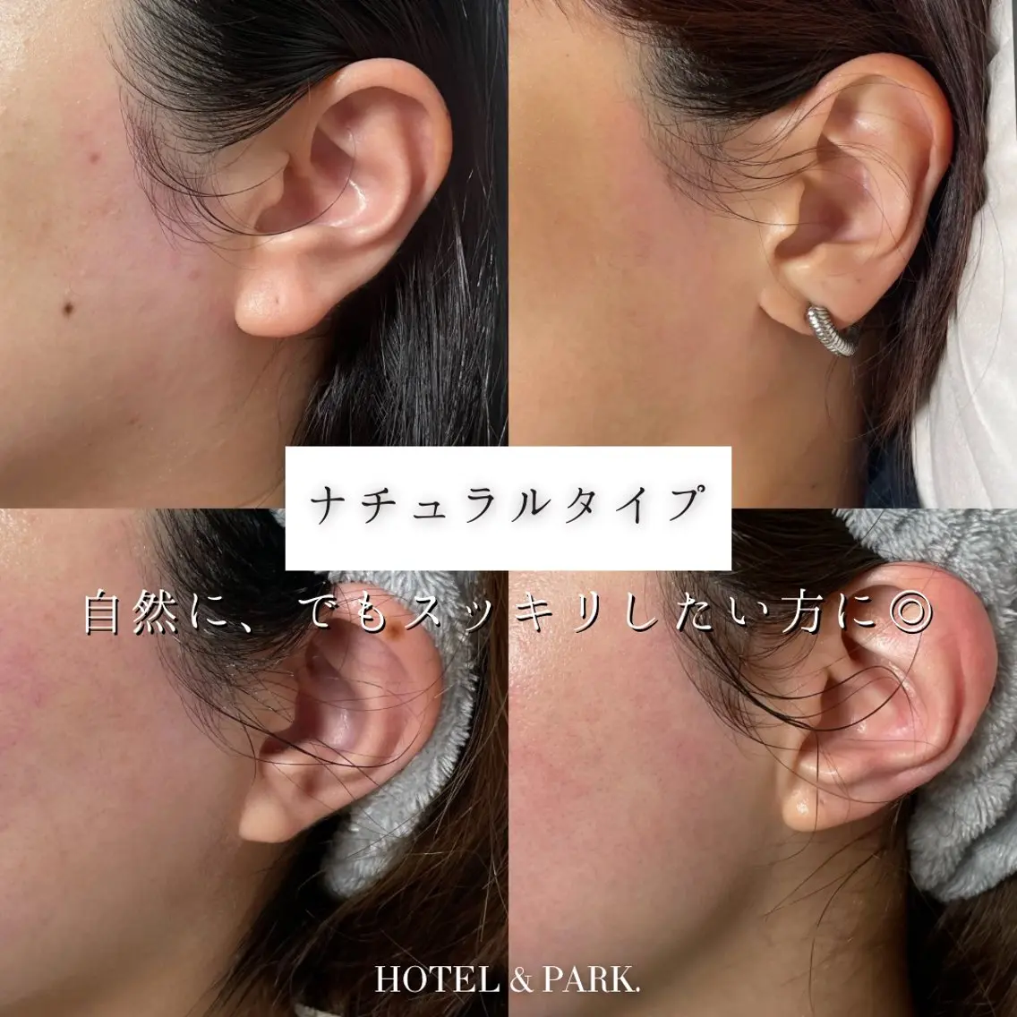 脱毛 HOTEL&PARK . ワックス脱毛のエステ・リラクイメージ