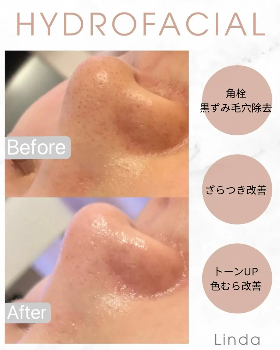 エステ 小顔&毛穴・肌質改善 LINDA西宮 AIのエステ・リラクイメージ