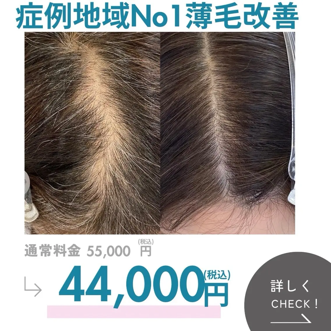 本気の薄毛改善 もう隠さない 頭皮集中改善ケアの写真