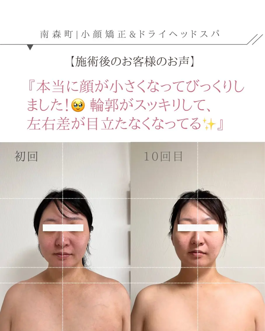 🌿 30代限定 3ヶ月間(6回来店条件)90分【顔むくみ解消/の余白をなくす小顔ヘッドスパ】の写真