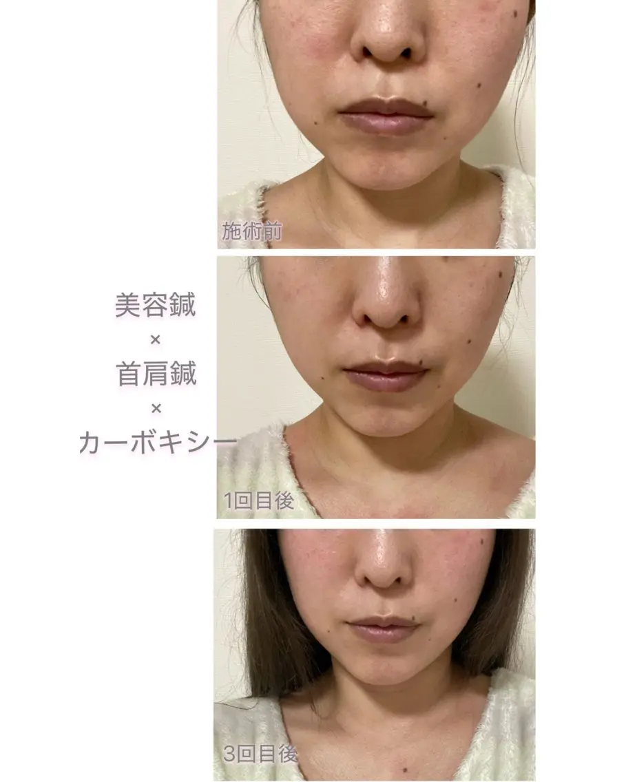 エステ リラク 美容鍼灸サロン YOSHINOのエステ・リラクイメージ