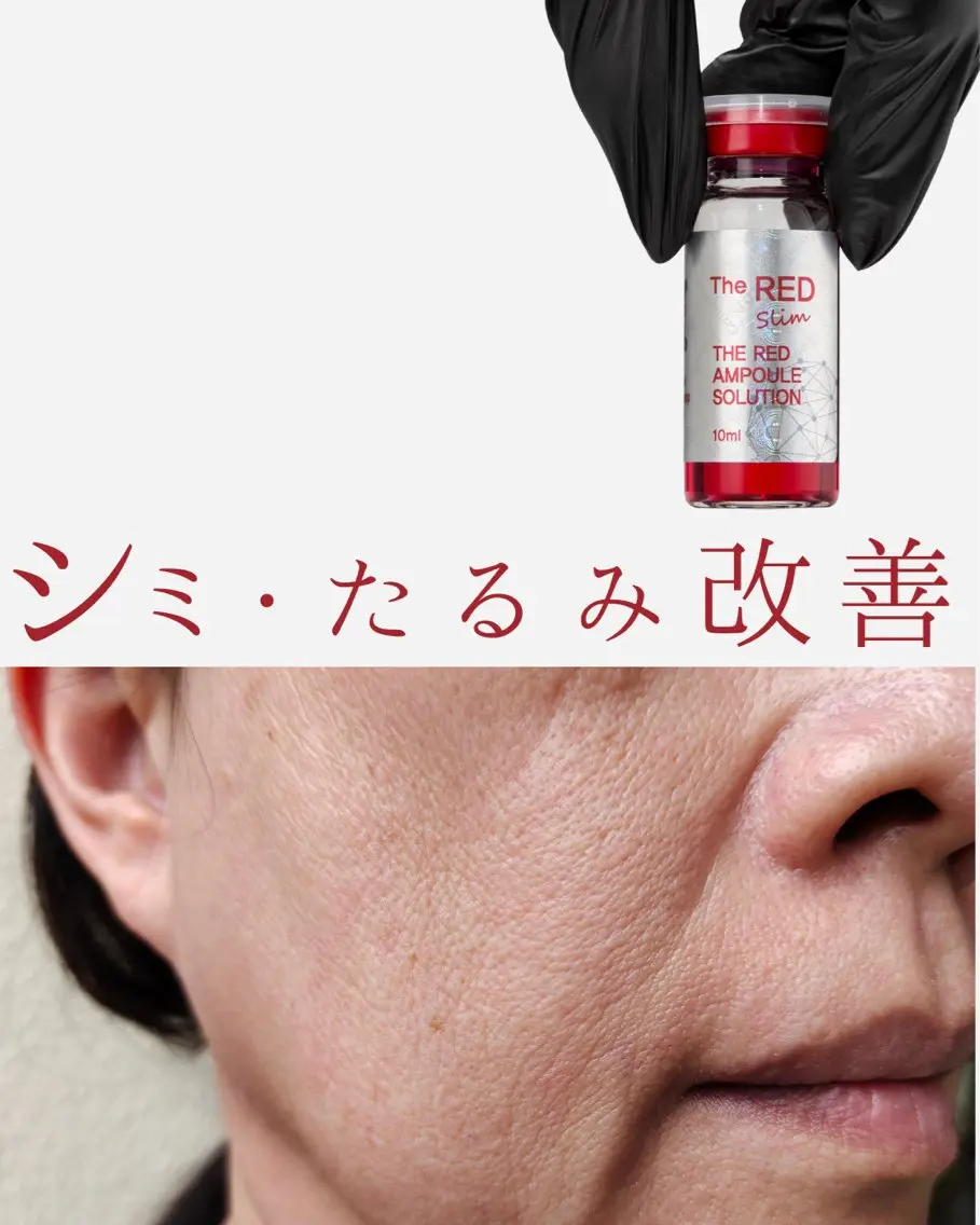 小顔フェイシャルお得モニター【REDSHOT】脂肪撃退美容液2ml使用/フォースカッターの写真