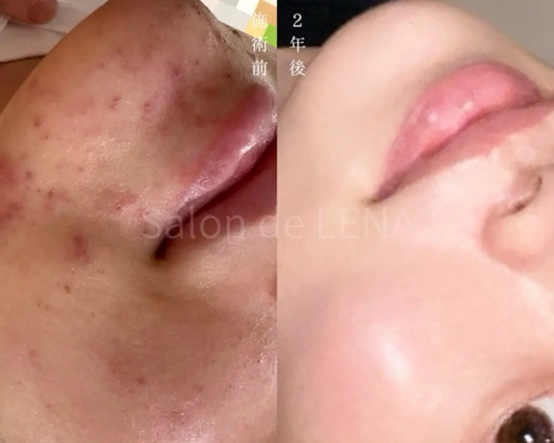 💫圧倒的人気No.1💫【本気の肌改善🌿】剥離ありハーブピーリング+高濃度鎮静パック💆♀️🫧顔限定💆🫧の写真