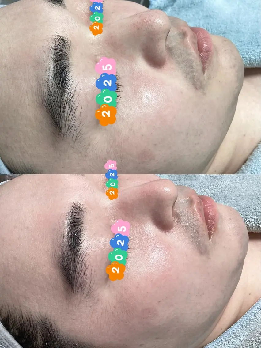 ツルツル白玉水光肌毛穴洗浄フェイシャルコース【メンズにもおすすめ】の写真