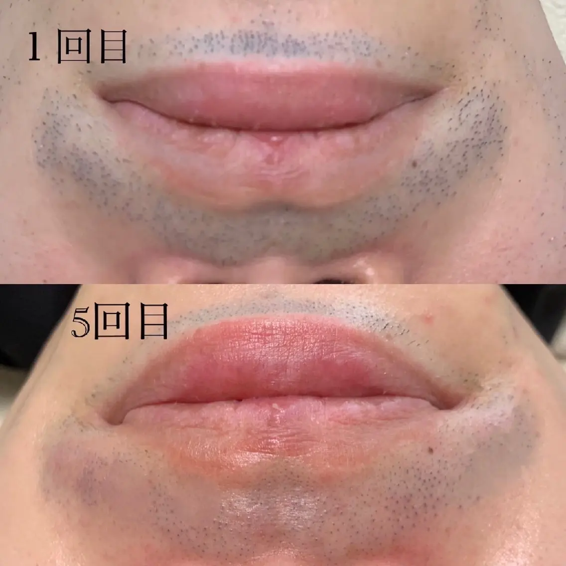 【夏直前50%OFF☀️】LED脱毛全身【顔.VIO無し】の写真