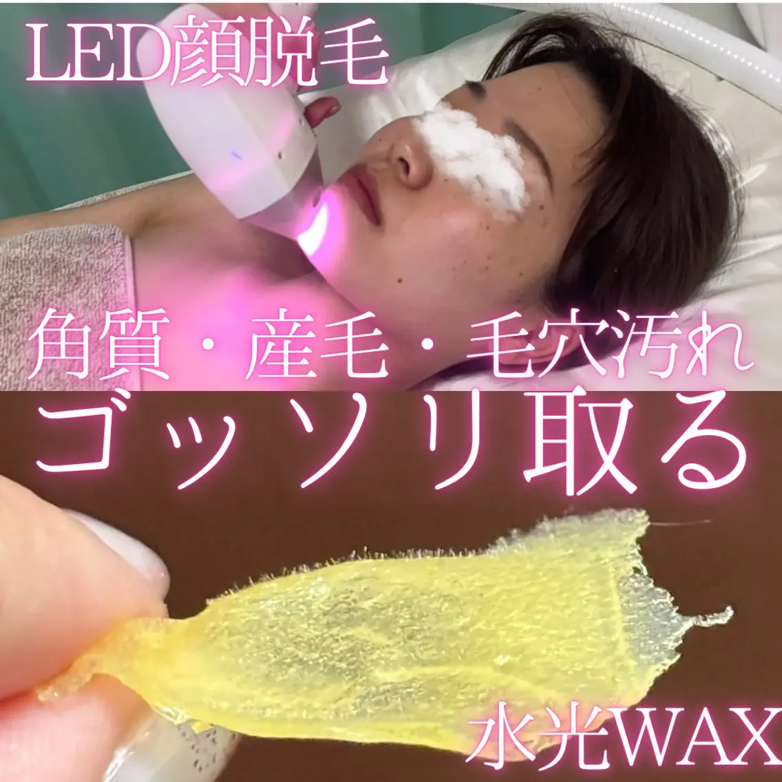 【ハイブリッド脱毛】マツヤニ水光WAX+顔LED脱毛✨産毛・毛穴汚れ・角質をごっそりケア！もちもちで透明感あるお肌に🩷の写真