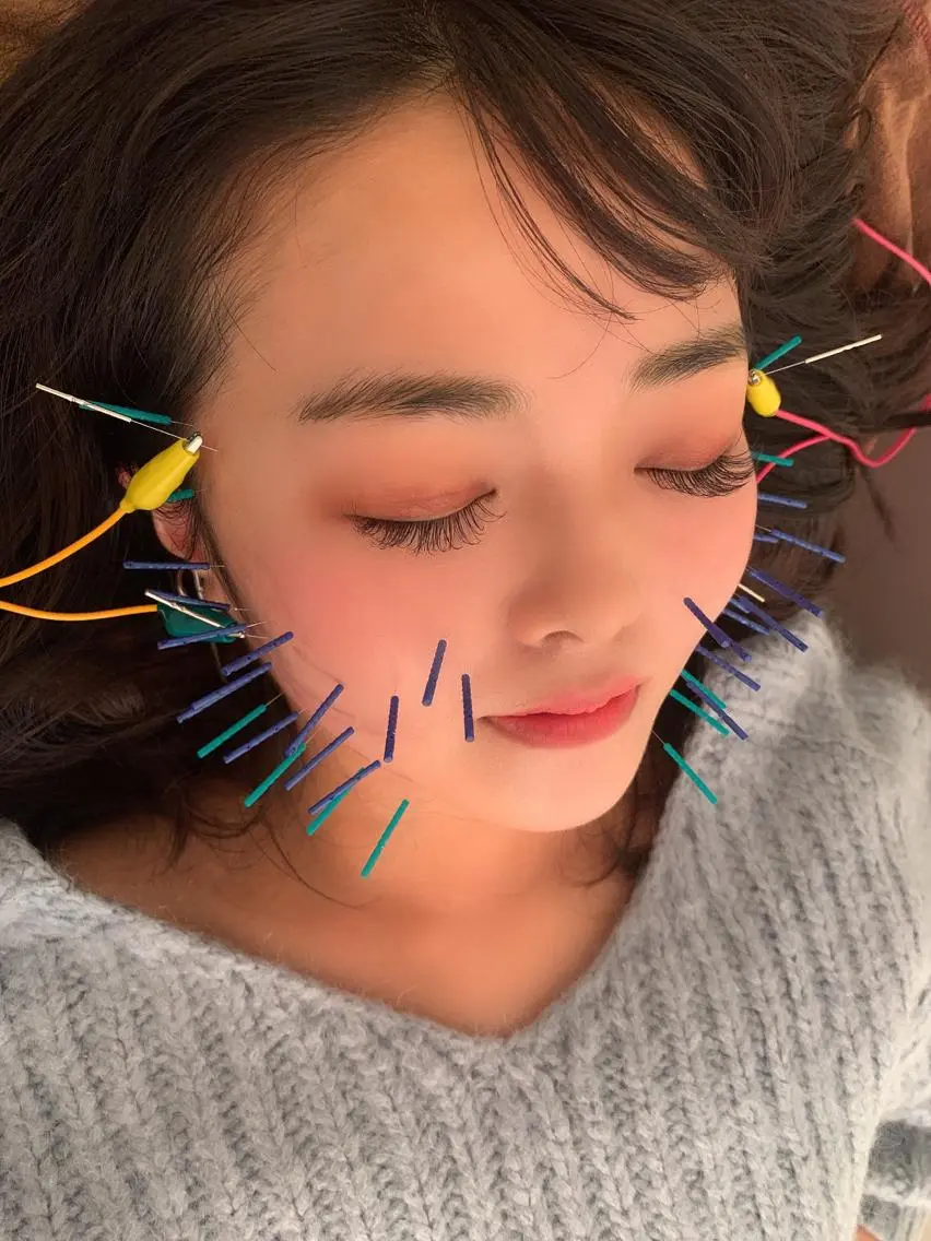 電気美容鍼メニューの写真