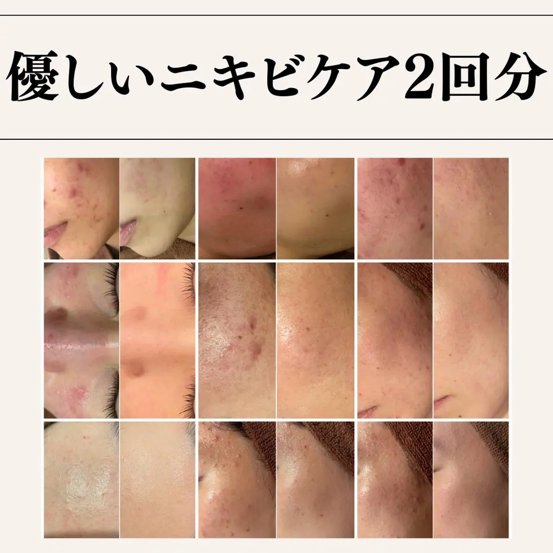 【まずはお試しから】ニキビ/ニキビ跡の炎症に刺激を与えずに集中アプローチ⚡フェイシャルチケット2回分⭐の写真