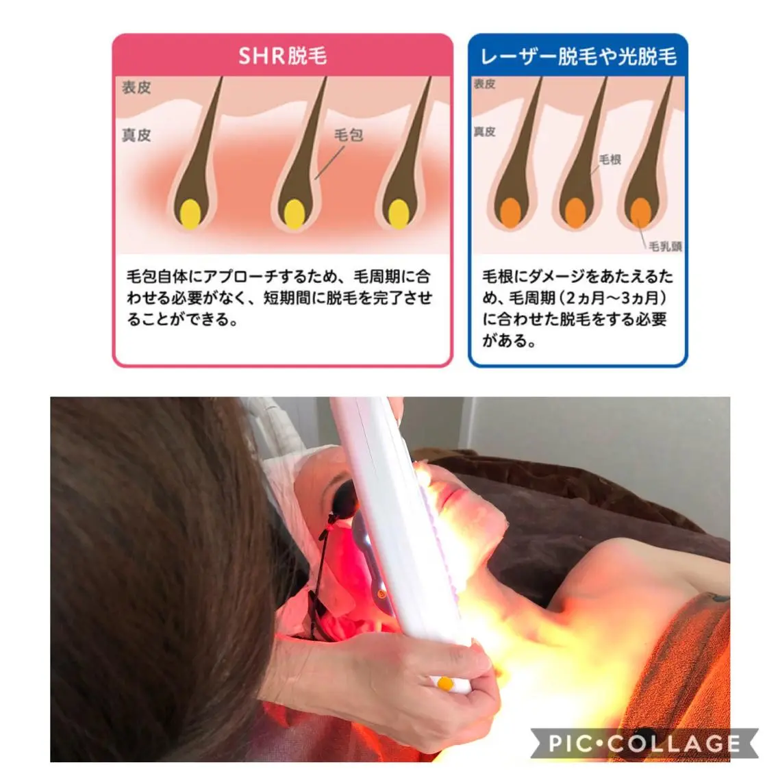 潤い・ハリ・美白！顔脱毛★3500円！！毛穴の引き締まり◎化粧のり◎の写真
