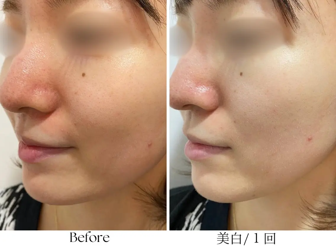 【美白/シミ/くすみ/日焼け/透明感】速攻美白フェイシャル☆美白ピーリングの写真