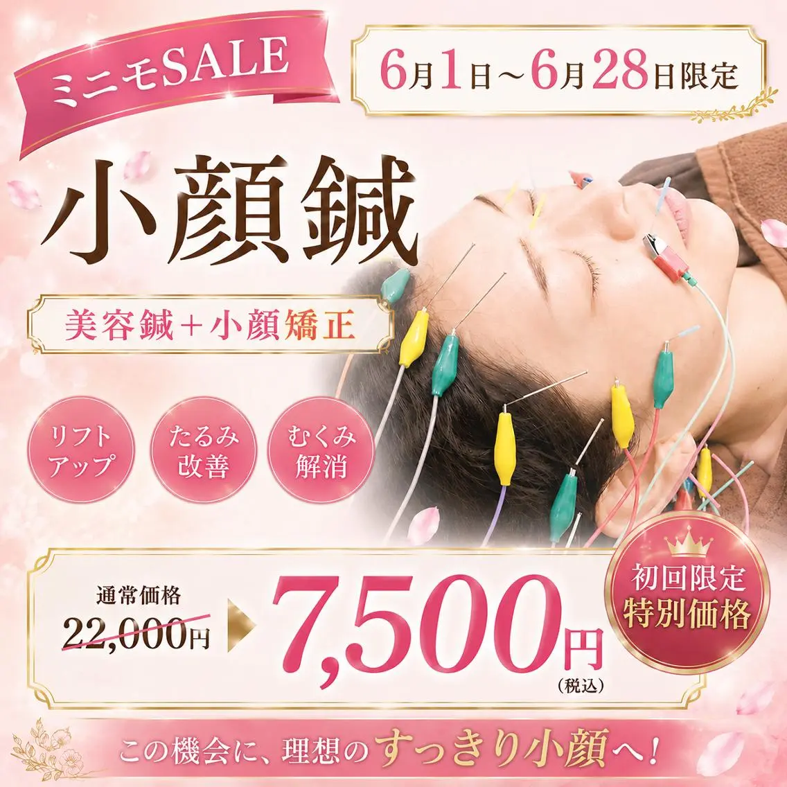6/1〜6/28限定!人気No1【小顔針】120分⭐️美容鍼+小顔矯正+フェイシャルマッサージの写真