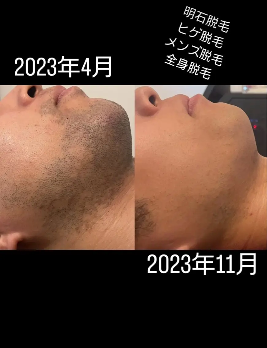 🩵メンズ🩵ヒゲ脱毛の写真