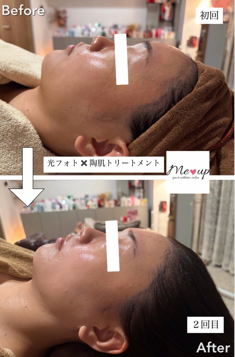 エステ Meup ニキビケア 毛穴・背中ニキビ専門のエステ・リラクイメージ
