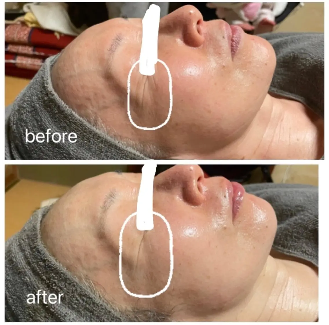 【深いシワさよなら細胞美容で若化が叶う🧬】陶肌トリートメント＋オプション🎁スキンケア半顔体験付きの写真