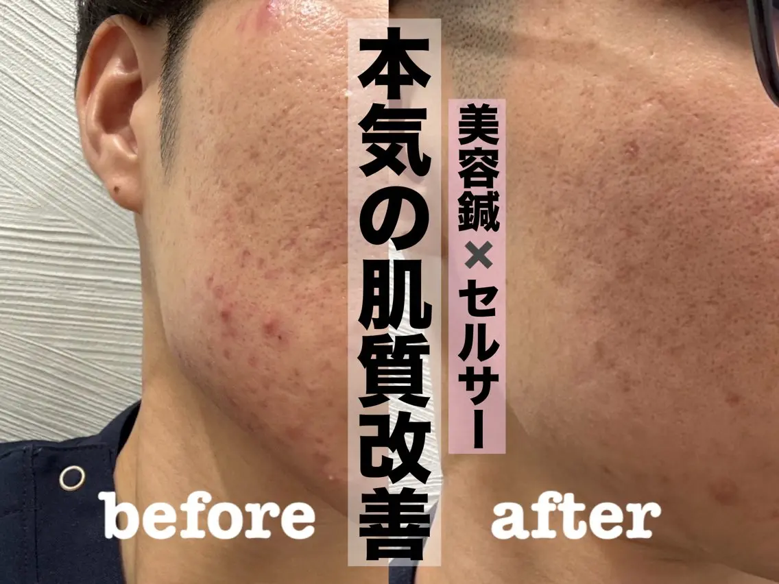 【肌質改善★人気No.1】セルサー＋美容鍼（100本）で赤み・ニキビ・肌質改善の写真