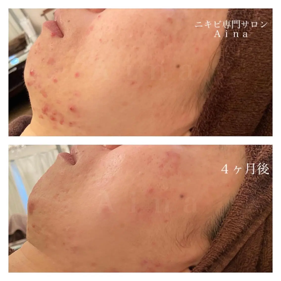セミロング カラー パーマ ヘアアレンジ メンズ キッズ ネイル マツエク・マツパ エステ リラク ニキビ跡専門サロン Ainaのエステ・リラクイメージ