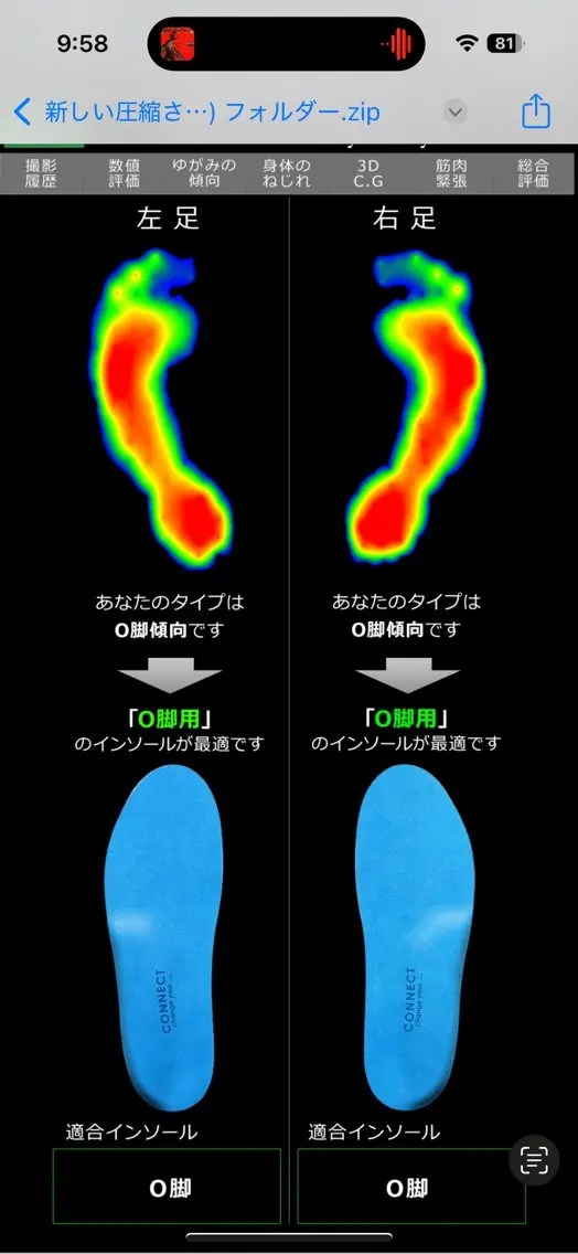 O脚改善の写真