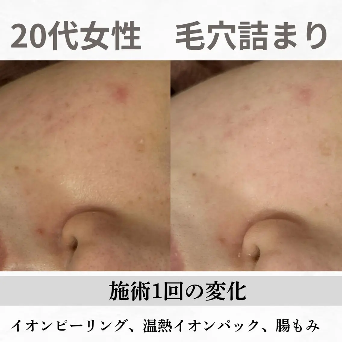 重度ニキビ専門🌼 ダウンタイムなしのエステ・リラクイメージ