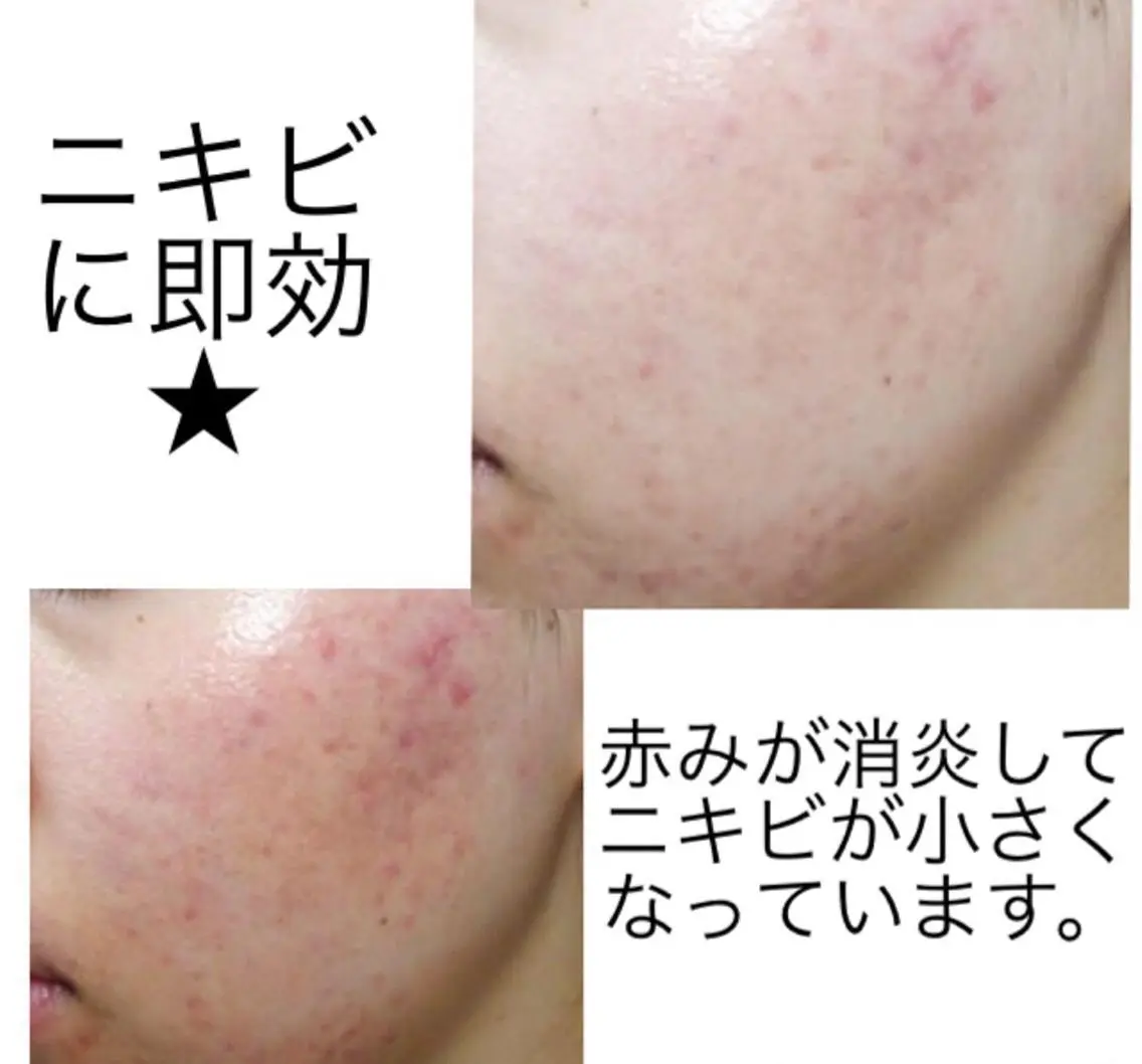 🫧ニキビケア【美肌活生】発光美白Glass skin 繰り返すニキビ.跡.凸凹. 赤み鎮静の写真