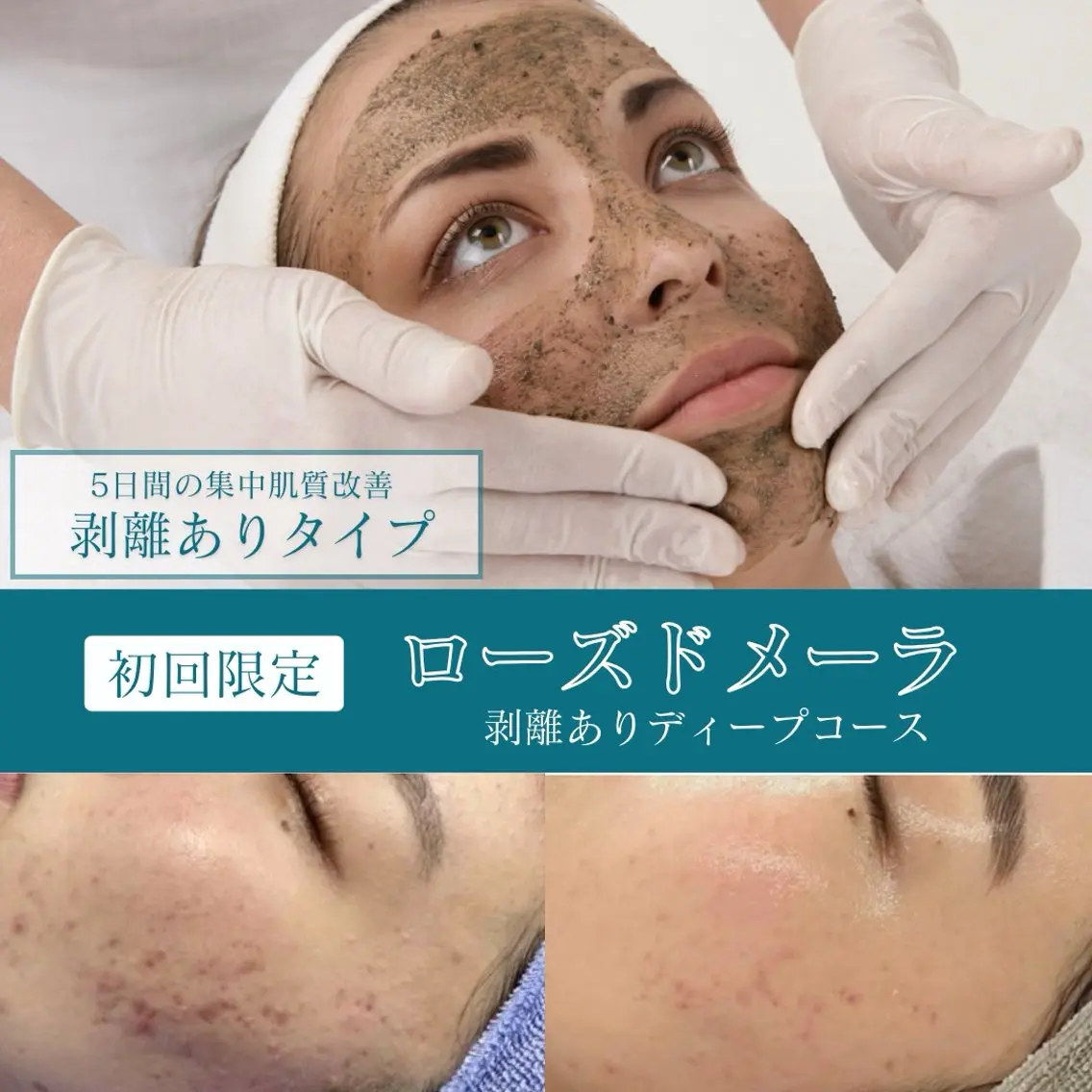 【6/12まで限定❗️】剥離ありハーブピーリング🌿5日間の集中肌管理✨ニキビ/ニキビ跡/凹凸/シミなど頑固な肌悩みに◎の写真