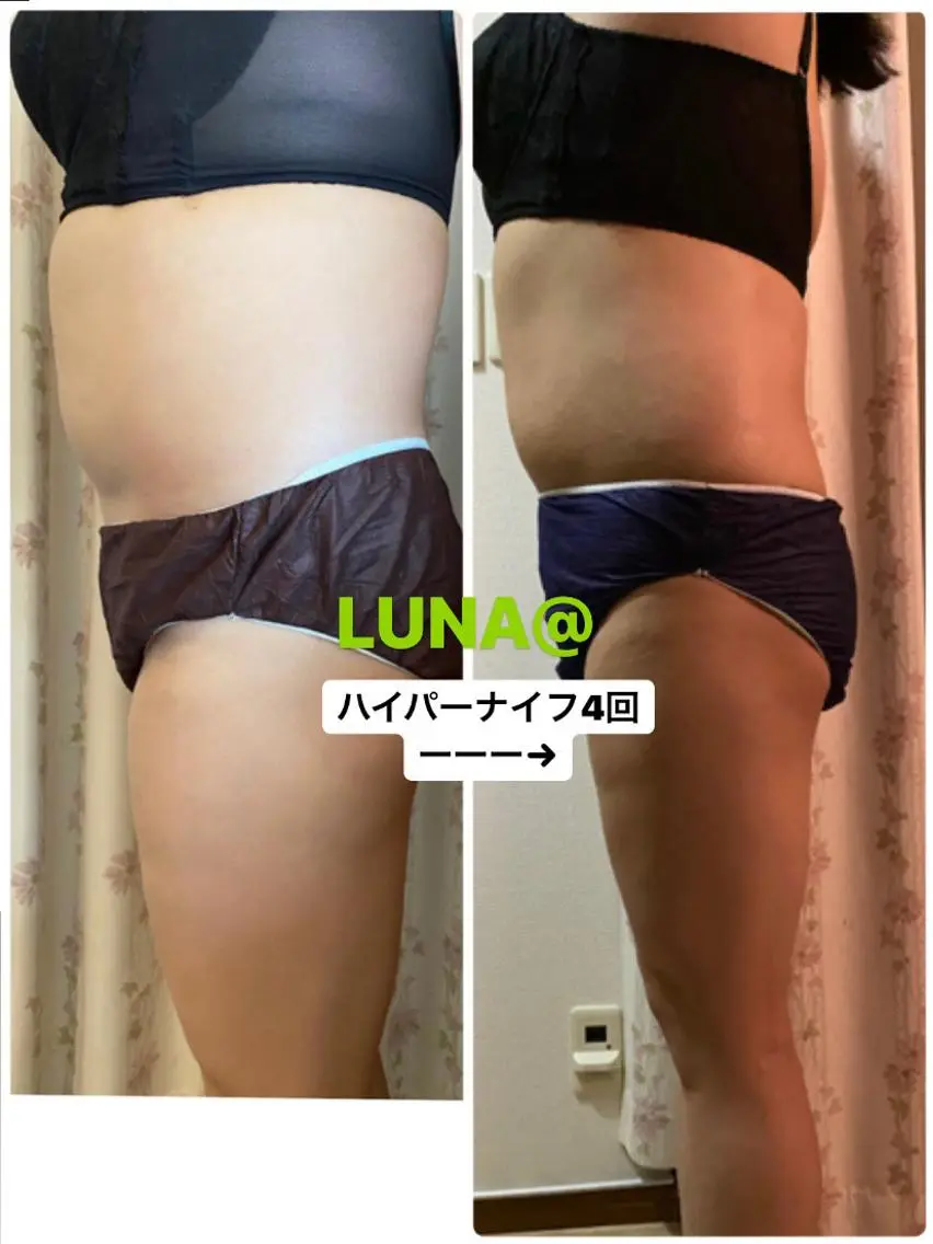 理想の美ボディーへ!首、肩スキリン、ヘッドマッサージ瘦身ハイパーナイフ+アロマリンパ+温活🔥120分12000円の写真