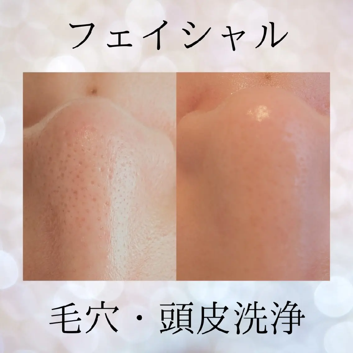 【よもぎ蒸し＆鼻のみ毛穴洗浄】夏に向けたインナーケアとフェイシャルのセット⛱️の写真