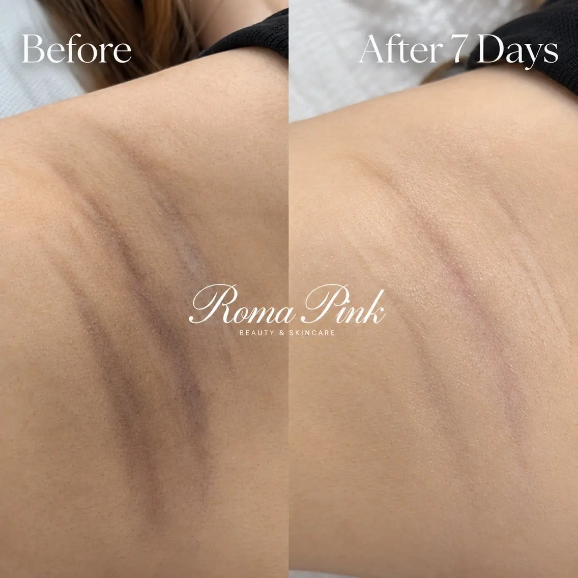 【RomaPink】ローマピンク施術 | 脇 ¥50,000の写真