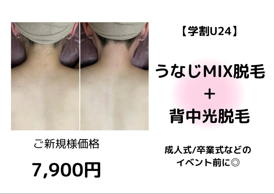 【うなじMIX＋背中光脱毛】卒業式、結婚式、イベント前に後ろ姿美人へ✨￥7900の写真