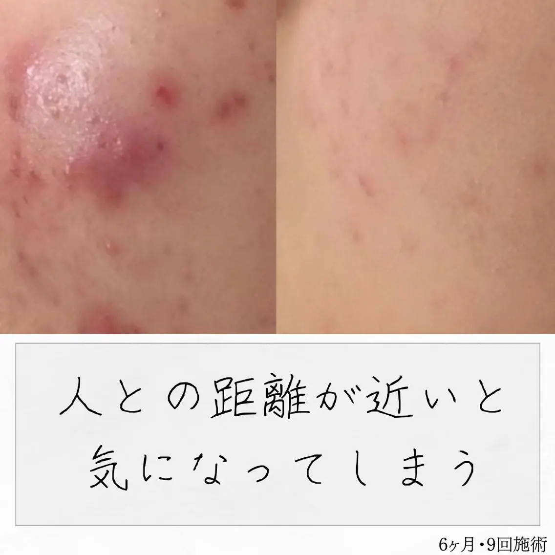 ニキビ経験者が施術 する専門サロン🌻のエステ・リラクイメージ