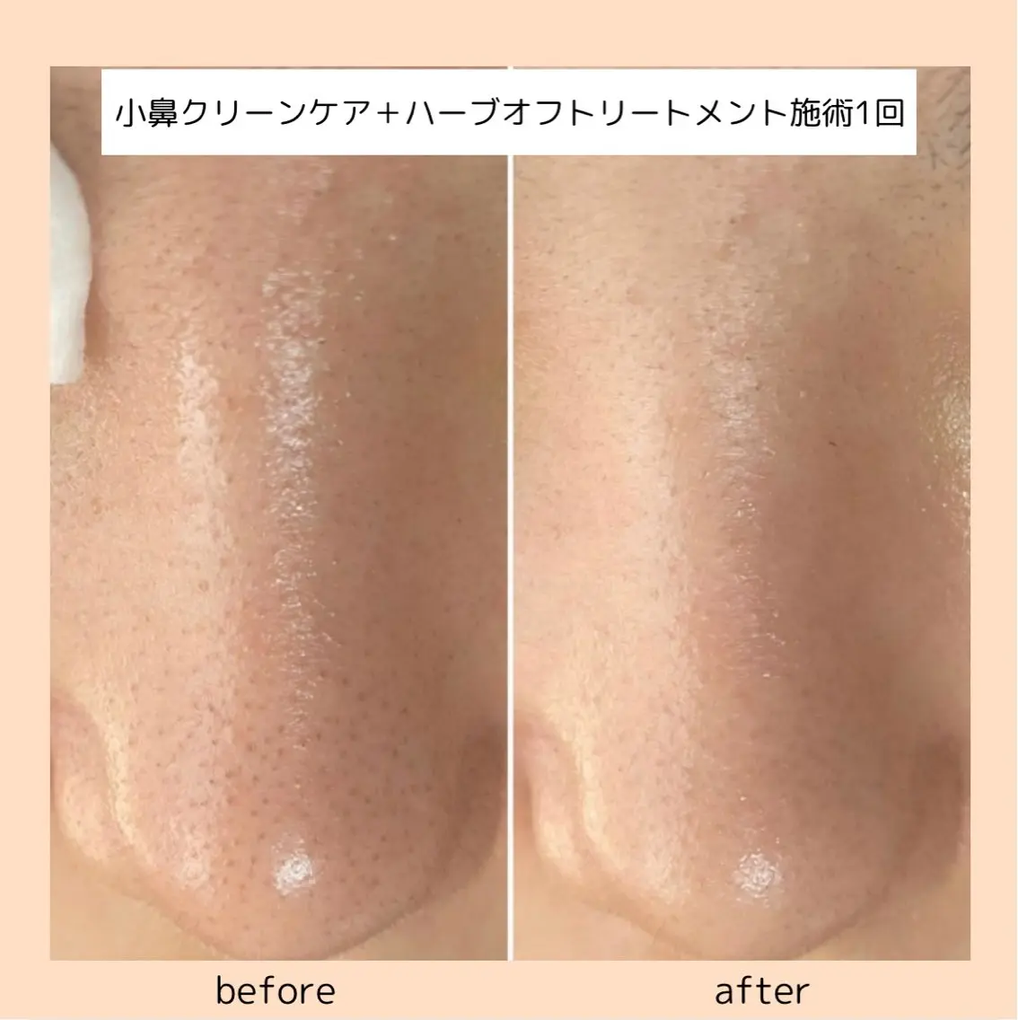 オススメ★小鼻クリーンケア+贅沢🌿ハーブオフトリートメントの写真