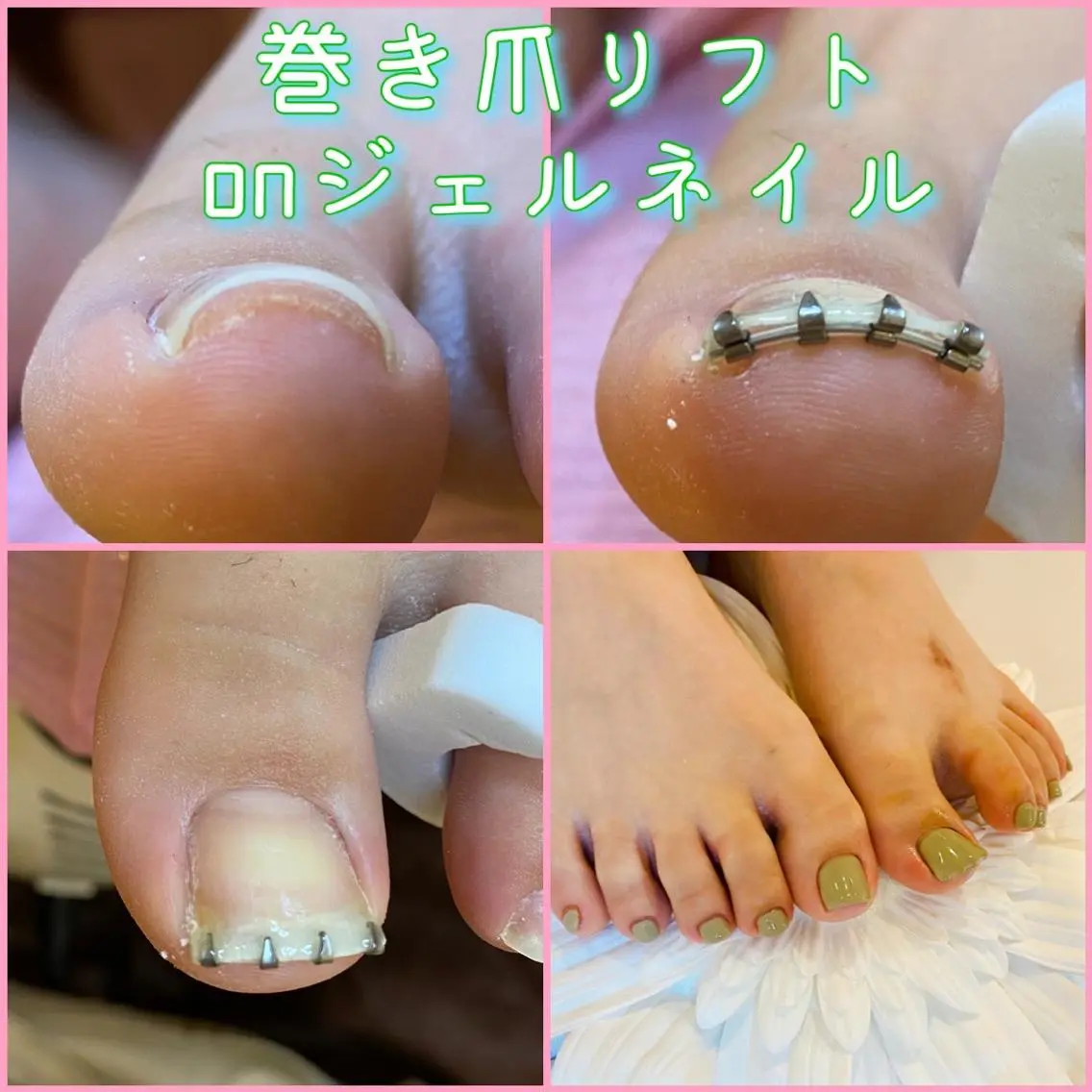 ネイル フットネイル 持ち込み 夏ネイル ♢ME2ROOM♢ #巻き爪#リラクのネイルデザイン