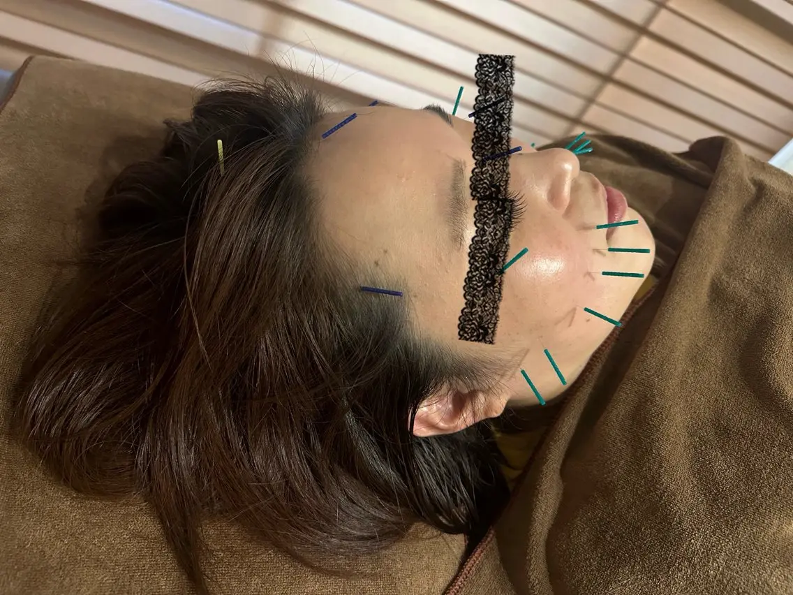 美容鍼の写真