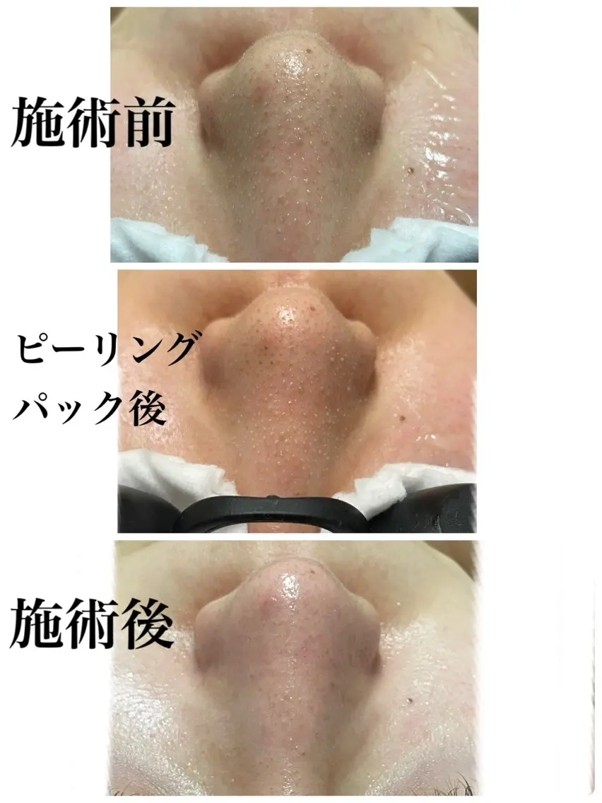 小鼻の毛穴洗浄の写真
