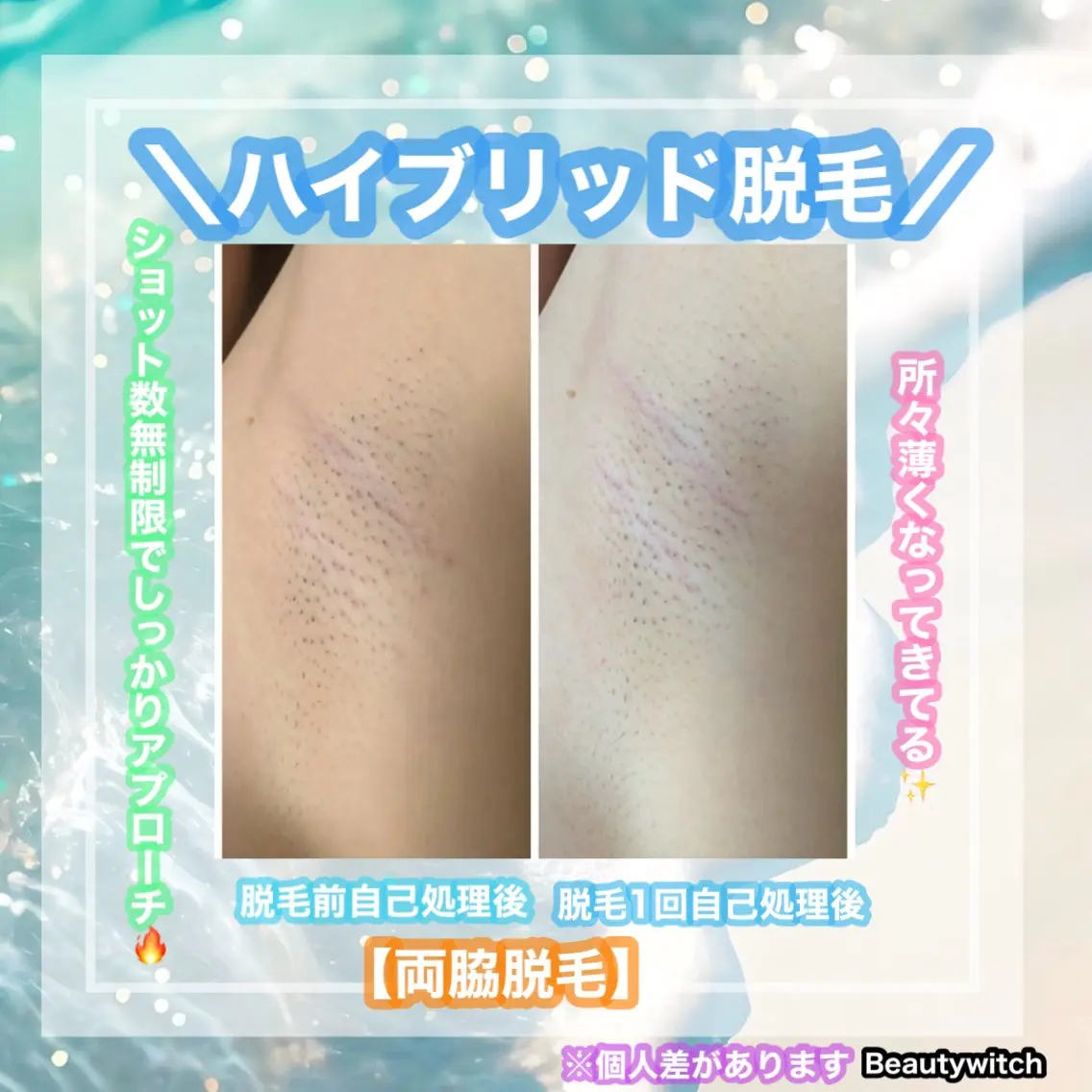 脱毛 痩身/脱毛/ネイル HARUKAのエステ・リラクイメージ