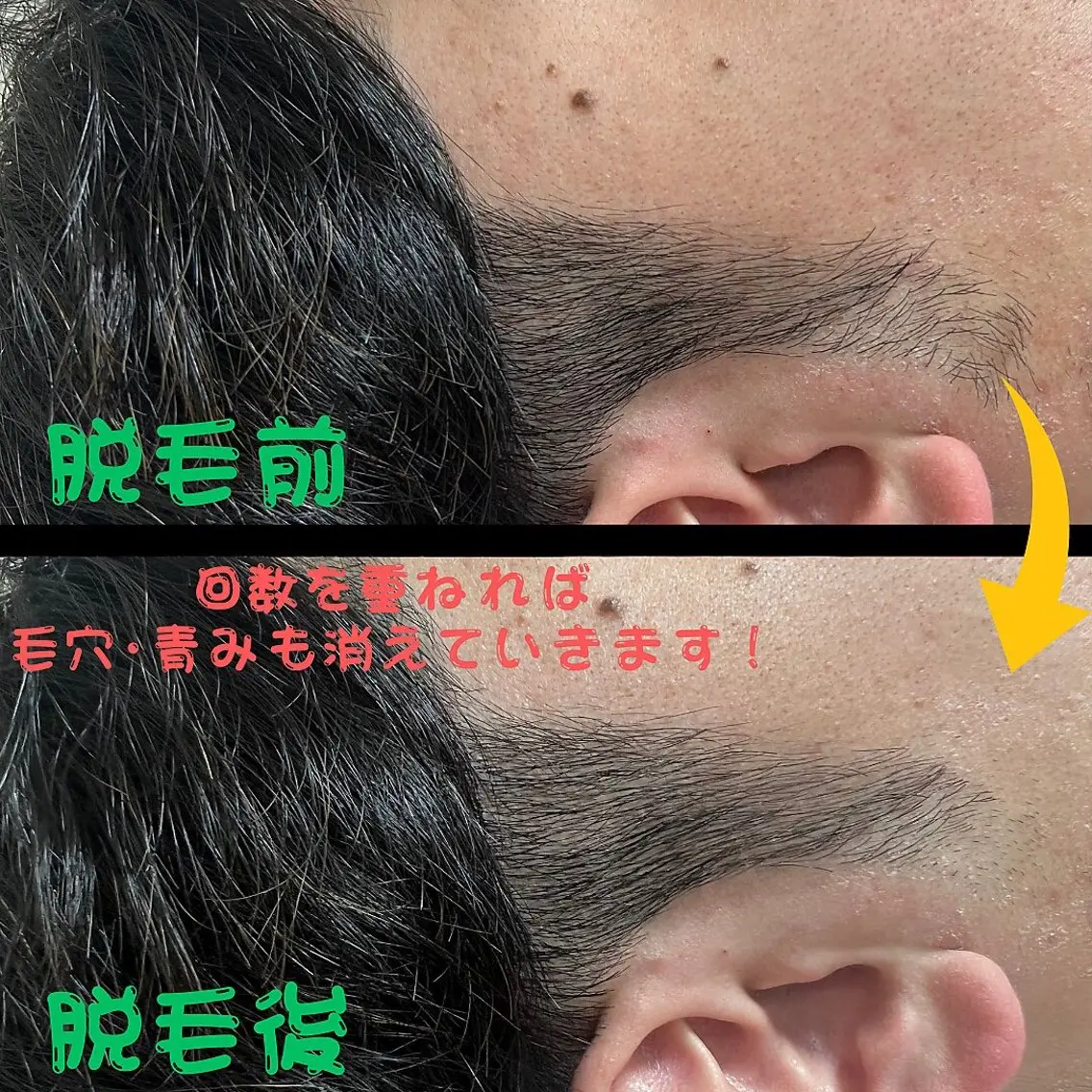 メンズ キッズ 脱毛 メンズ脱毛フェリッセ /男女🆗キッズ🆗のエステ・リラクイメージ