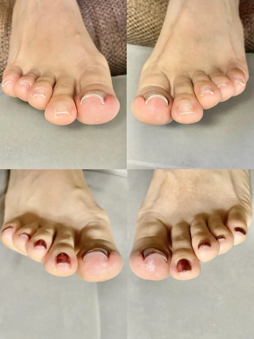 👣巻き爪ケアジェル　両足親指、ワンカラー込みの写真