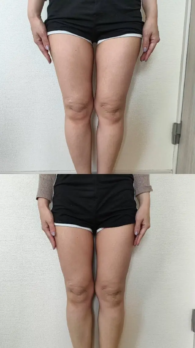 「着たい服」を諦めない。大人のための部分彫刻キャビテーション 45分（1​〜​2部位）の写真