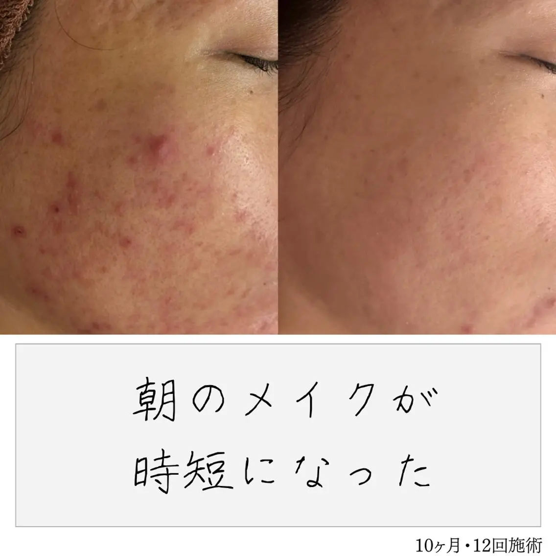 ニキビ経験者が施術 する専門サロン🌻のエステ・リラクイメージ