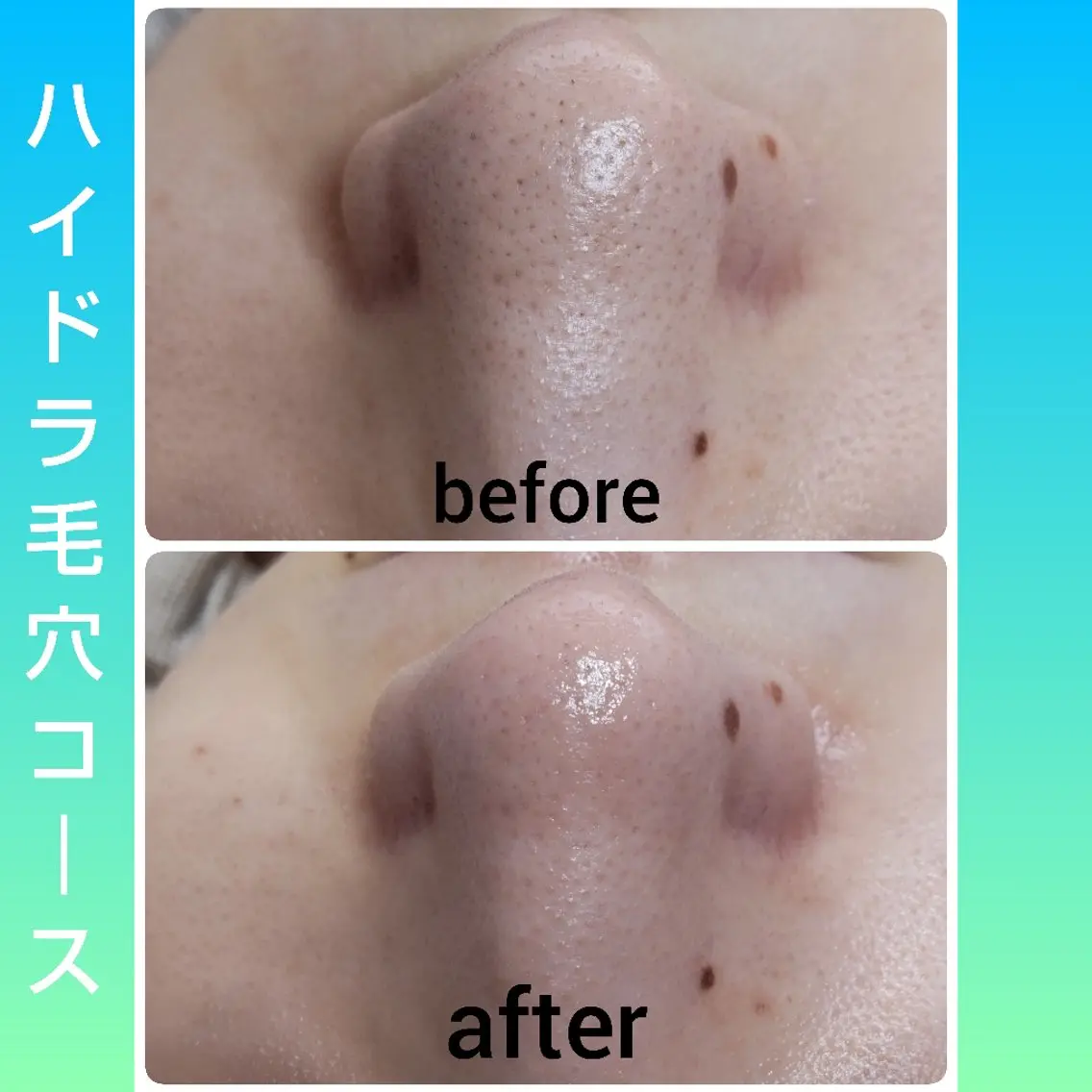 角質・毛穴洗浄🌼 脱毛🌸嶋津弘美のエステ・リラクイメージ