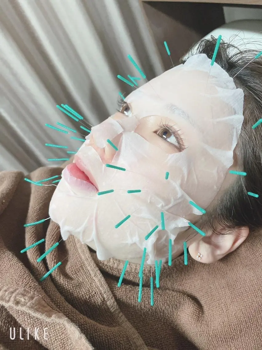 プラセンタ１００本美容鍼の写真