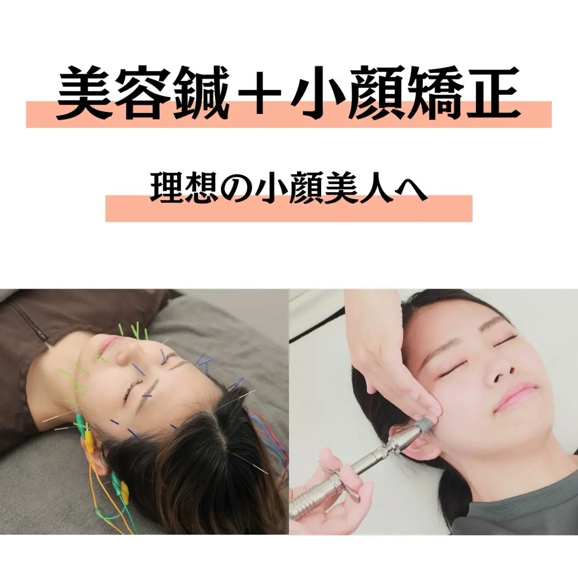 《🪡初回限定🪡》美容鍼＋小顔矯正＋ドライヘッドスパ（60分）　💄メイクオフ不要💄の写真