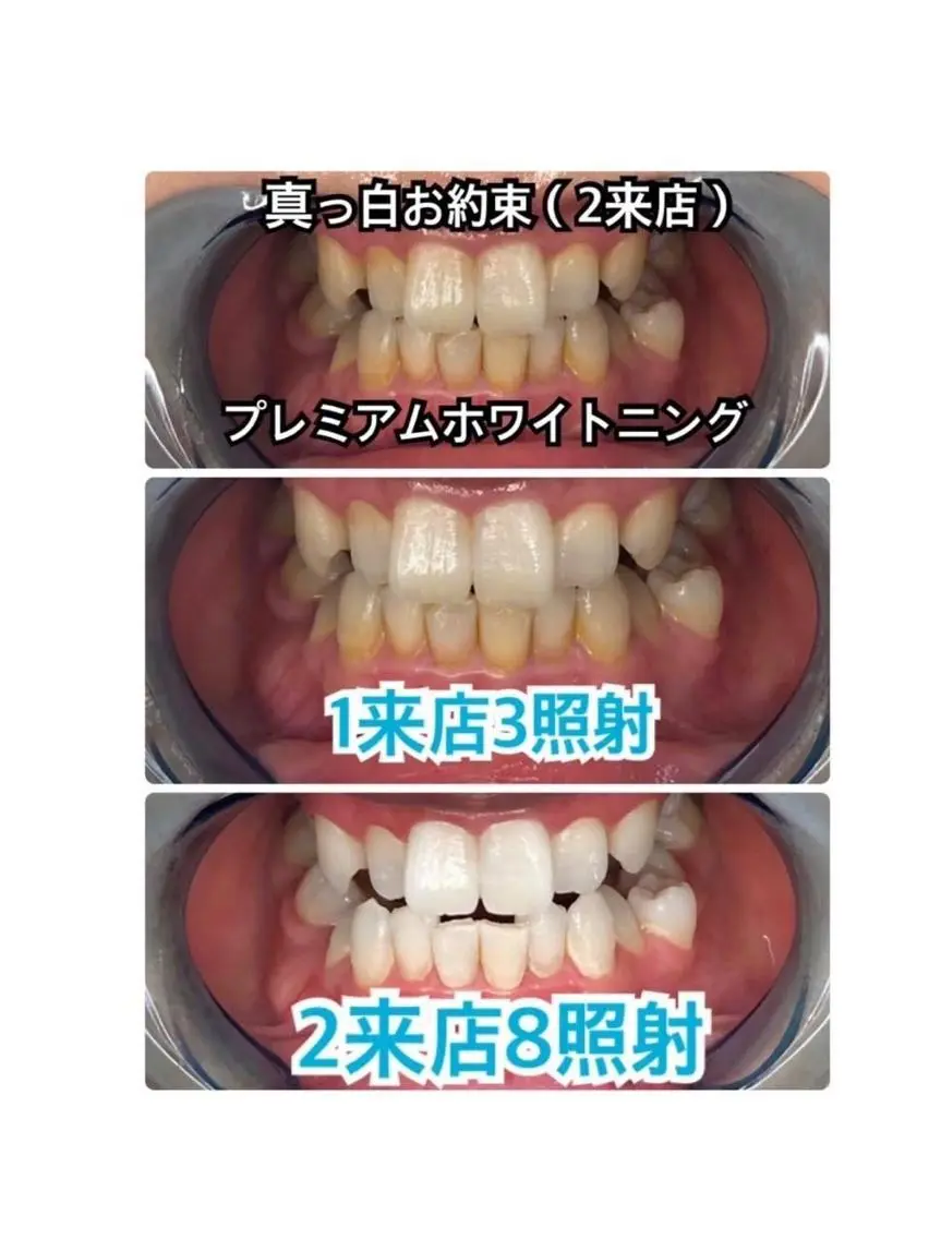 超超お得にホワイトニング❤️歯に色が定着し色落ち心配なし!プレミアムホワイトニング🦷(計3来店110分照射)の写真