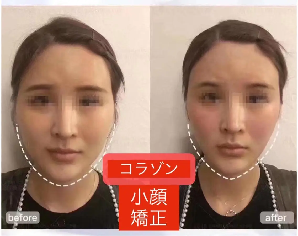 頭蓋骨小顔矯正の写真